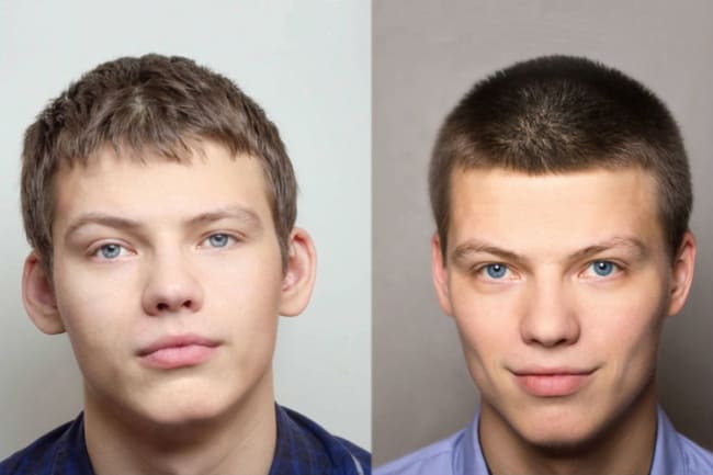 antes e depois de otoplastia