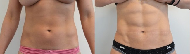 antes e depois de lipo HD em barriga feminina