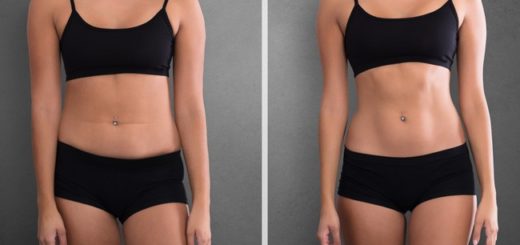antes e depois de lipo de alta definicao na barriga