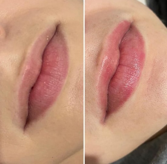 antes e depois de micropigmentacao labial em tom de rosa