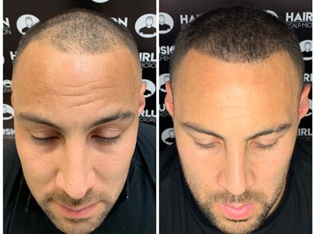 antes e depois de micropigmentacao capilar masculina