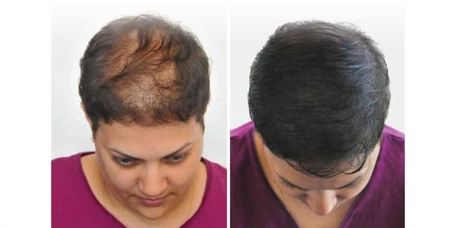 antes e depois de micropigmentacao capilar em cabelo curto feminino