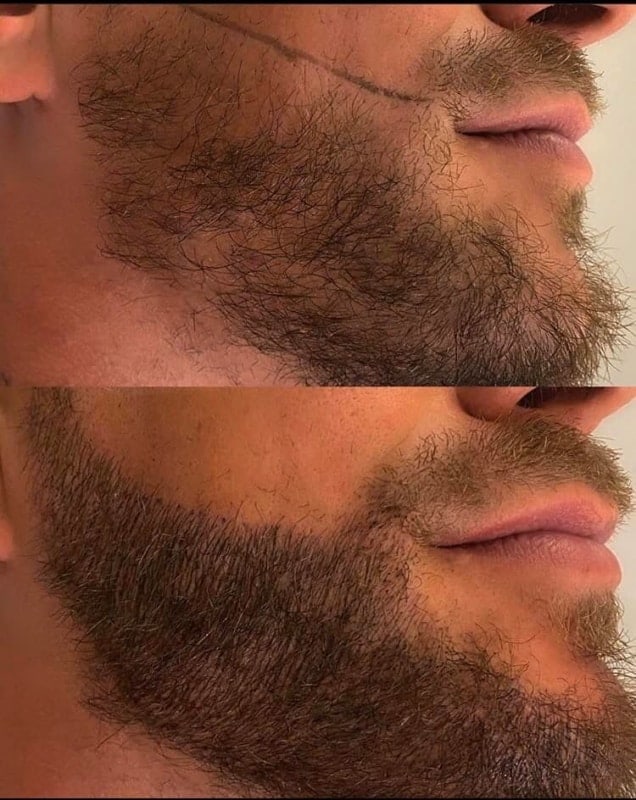 antes e depois de micropigmentacao masculina na barba