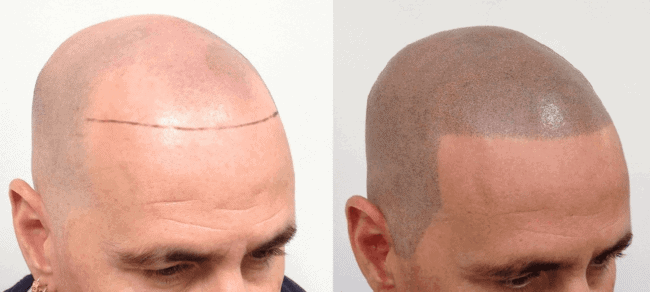 antes e depois de micropigmentacao masculina