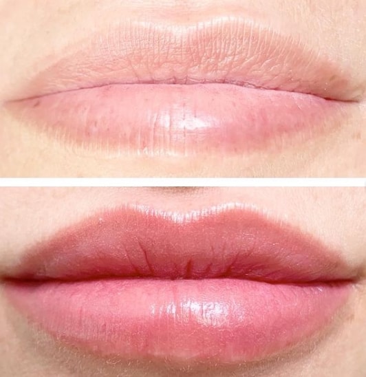 antes e depois de pigmentacao na boca
