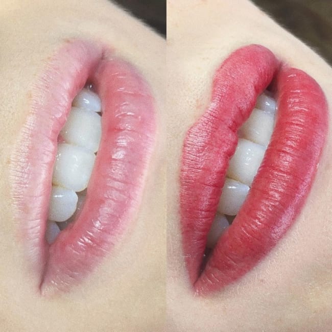 resultado antes e depois de pigmentacao nos labios