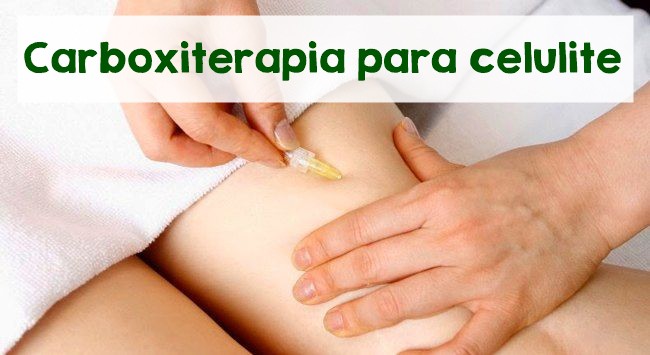 carboxiterapia para celulite