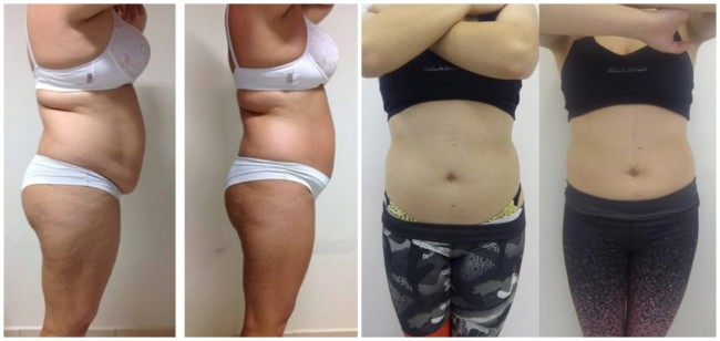 fotos de antes e depois de carboxiterapia em gordura localizada