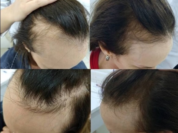 resultados de carboxiterapia cabelo feminino