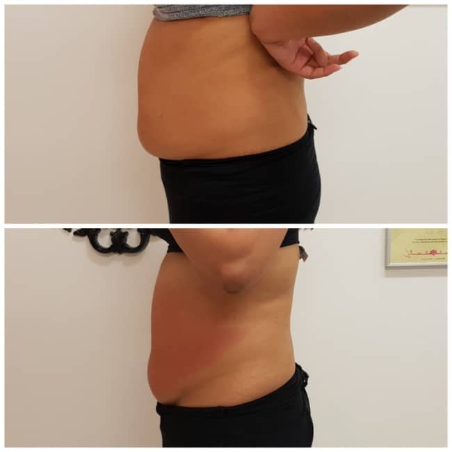 antes e depois de tratamento na barriga