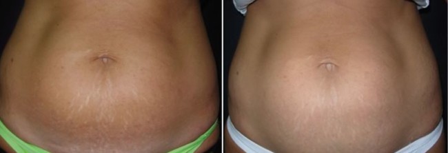 antes e depois de carboxiterapia para estrias na barriga