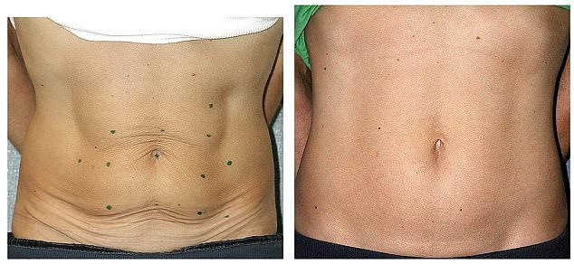 antes e depois de carboxiterapia para flacidez na barriga