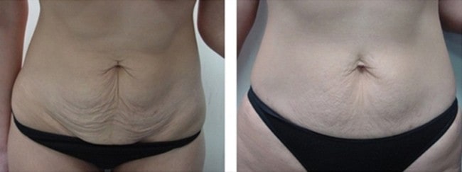 antes e depois de carboxiterapia para flacidez na barriga