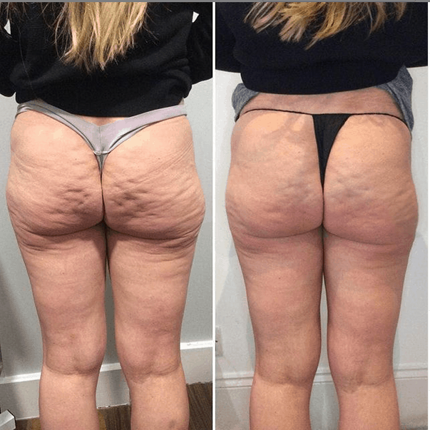 antes e depois de carboxiterapia na perna e bumbum