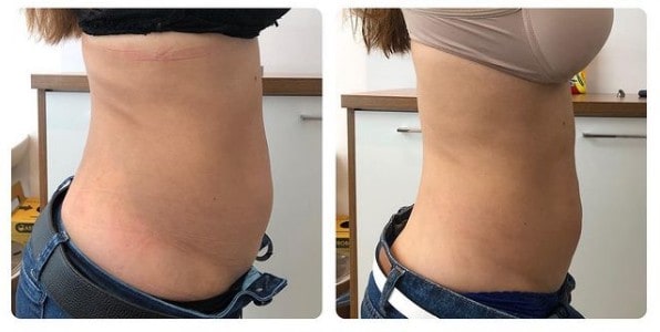 antes e depois de carboxiterapia na barriga