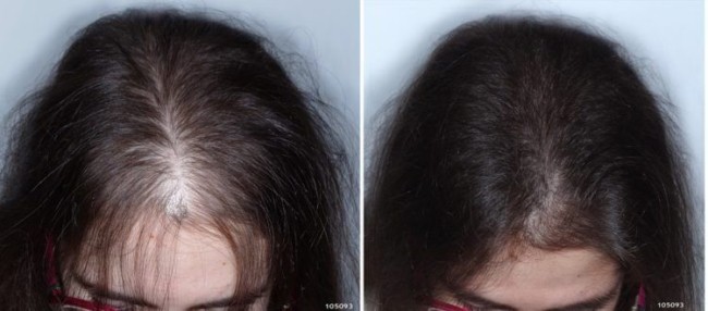 antes e depois de cabroxiterapia para alopecia feminina