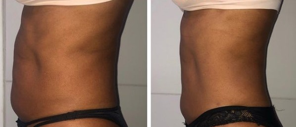 resultado antes e depois de carboxiterapia na barriga