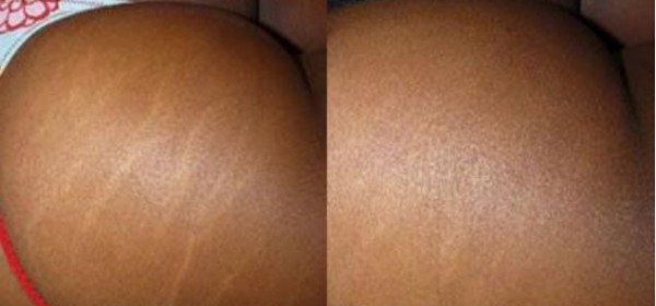 resultado de carboxiterapia para estrias em pele negra