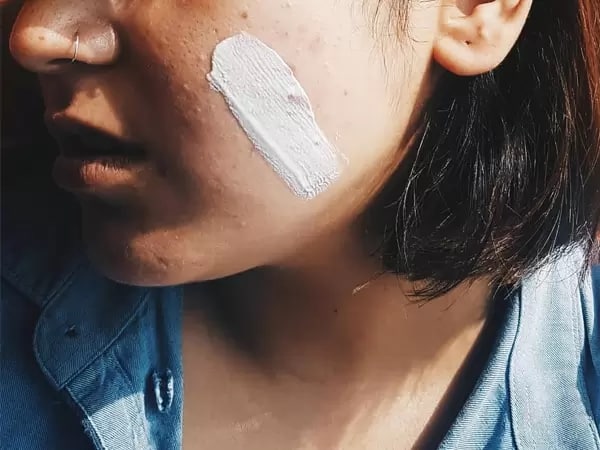 12 skincare para rosto com manchas de espinha iDiva