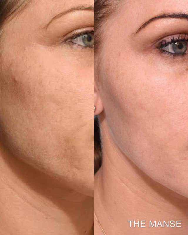 8 antes e depois de skinbooster The Manse Clinic