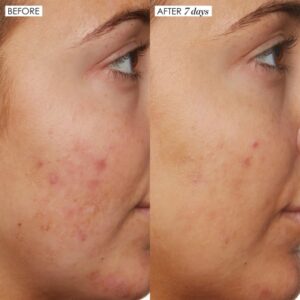 Niacinamida – 6 benefícios, como usar + antes e depois!