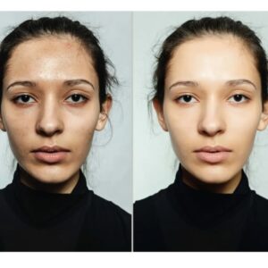 Niacinamida – 6 benefícios, como usar + antes e depois!