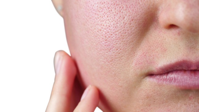 3 causas de poros dilatados Eden Skin Clinic