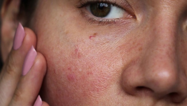 4 diferença pele sensível e pele sensibilizada Dermalogica UK